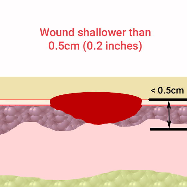 Tunnel Wound
