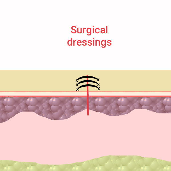 Tunnel Wound